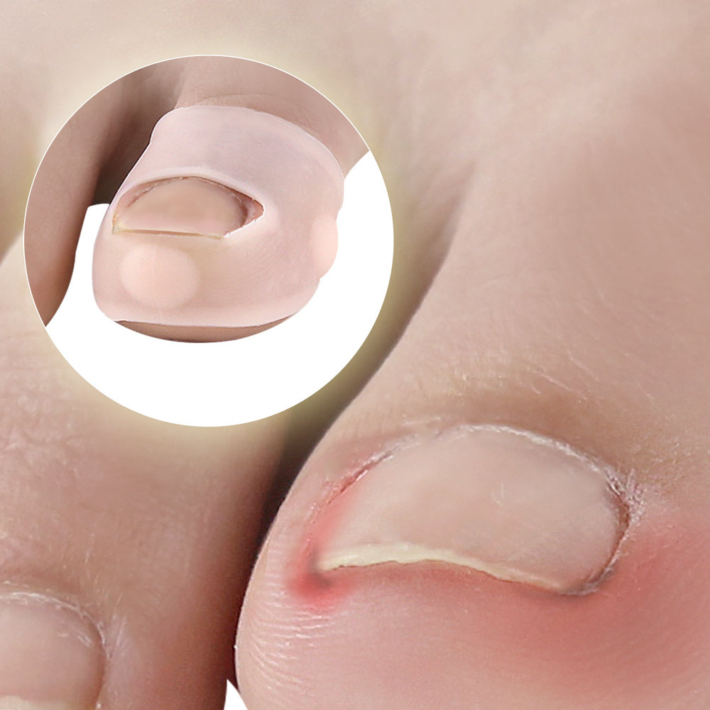 Before-and-after comparison showing fiery inflamed ingrown nail versus flat, corrected nail with product in place