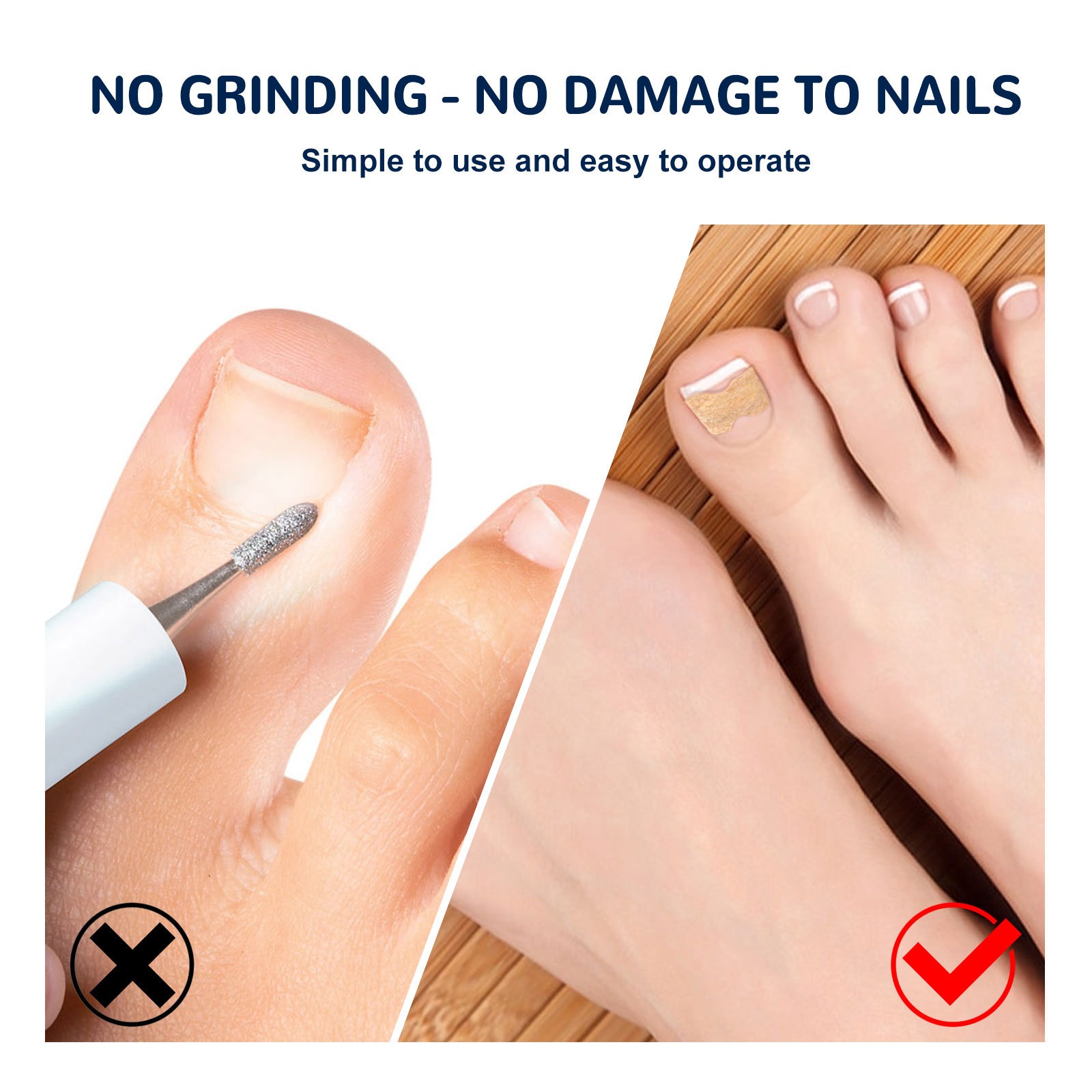 Comparison showing incorrect grinding method (X) versus correct patch application (checkmark) on toenails with wooden background
