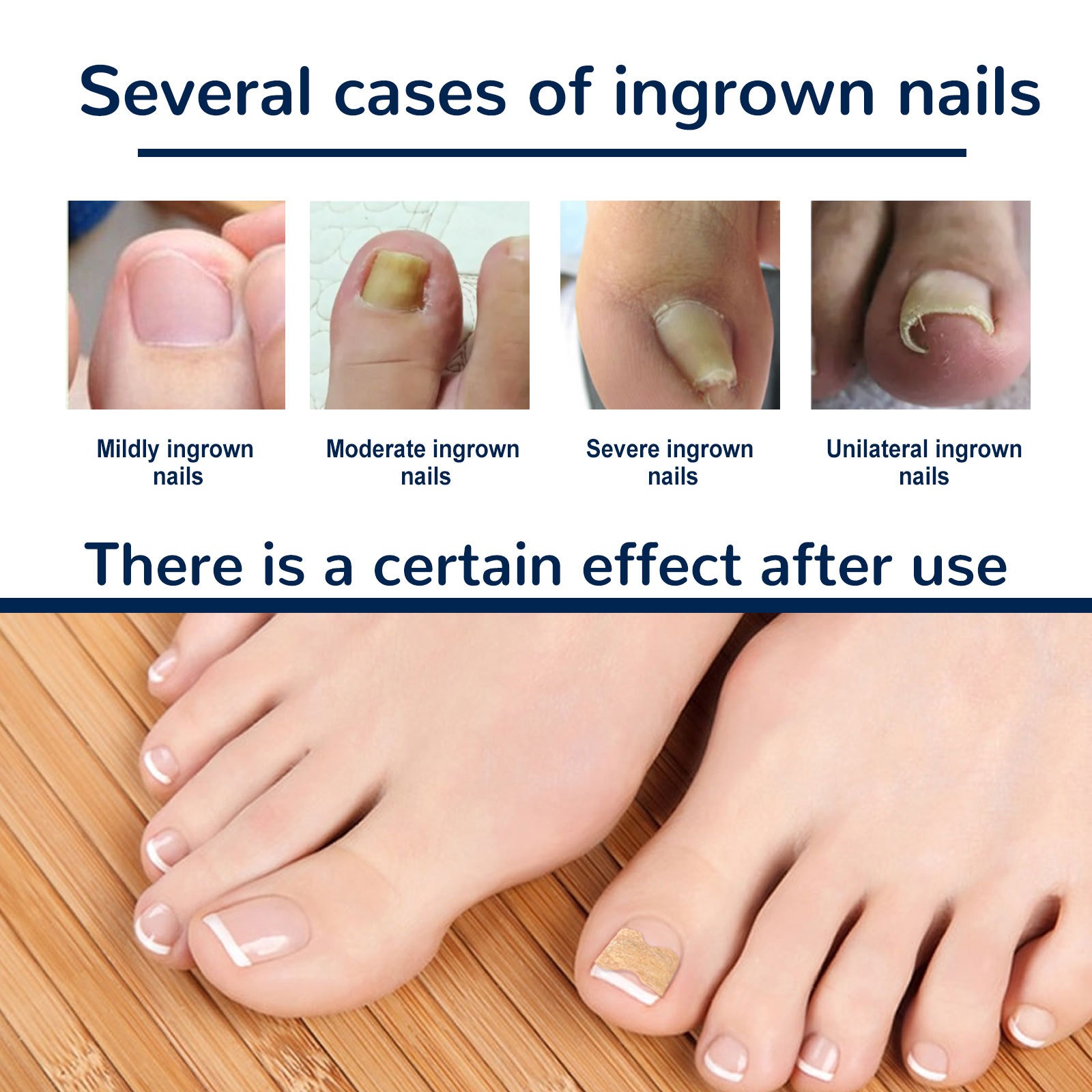 Close‑up of corrected toenail after using patches, showing smooth edge and natural shape