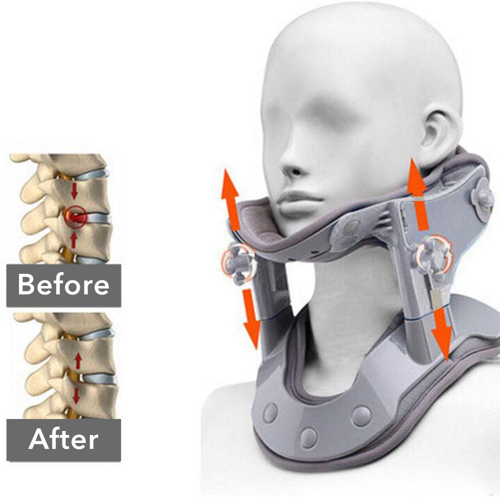 Medical before-after spinal diagram showing vertebral misalignment and correction with inflatable cervical collar