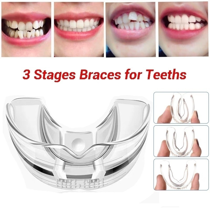 Four-panel progression showing teeth transformation from severely misaligned to perfectly straight across stages