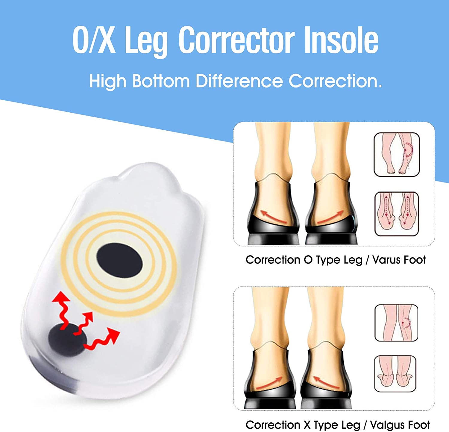 Before and after full leg comparison showing dramatic correction of O-type bow legs into straight aligned legs