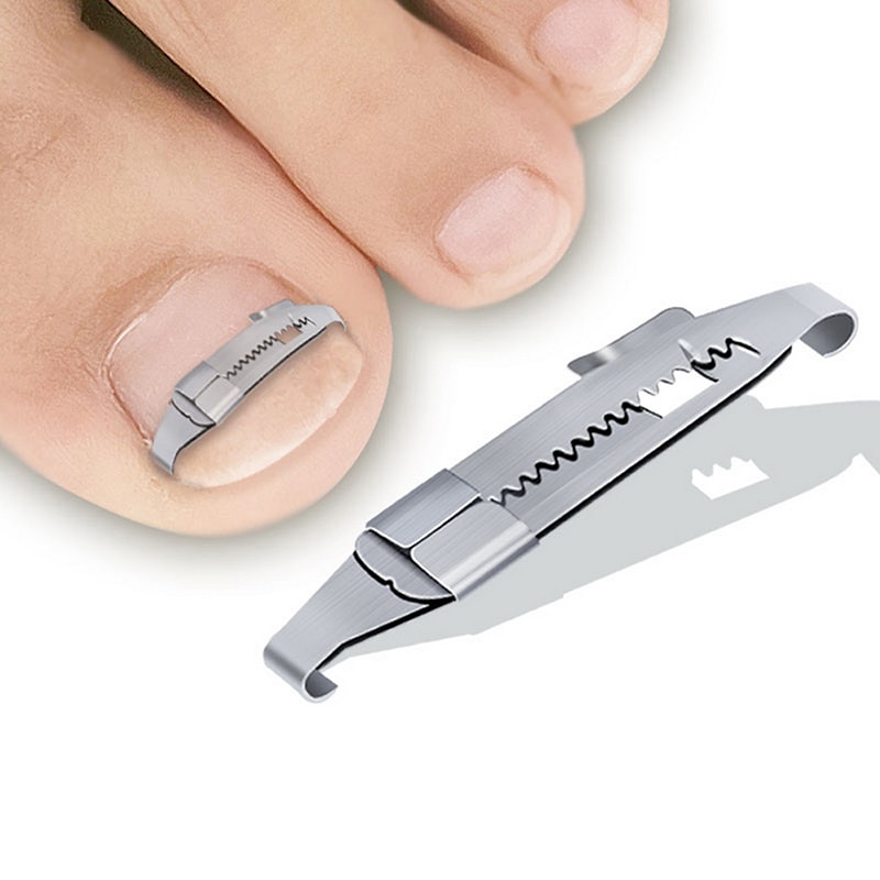 OrthoFix Pro - tool for correcting ingrown toenails-2.jpg