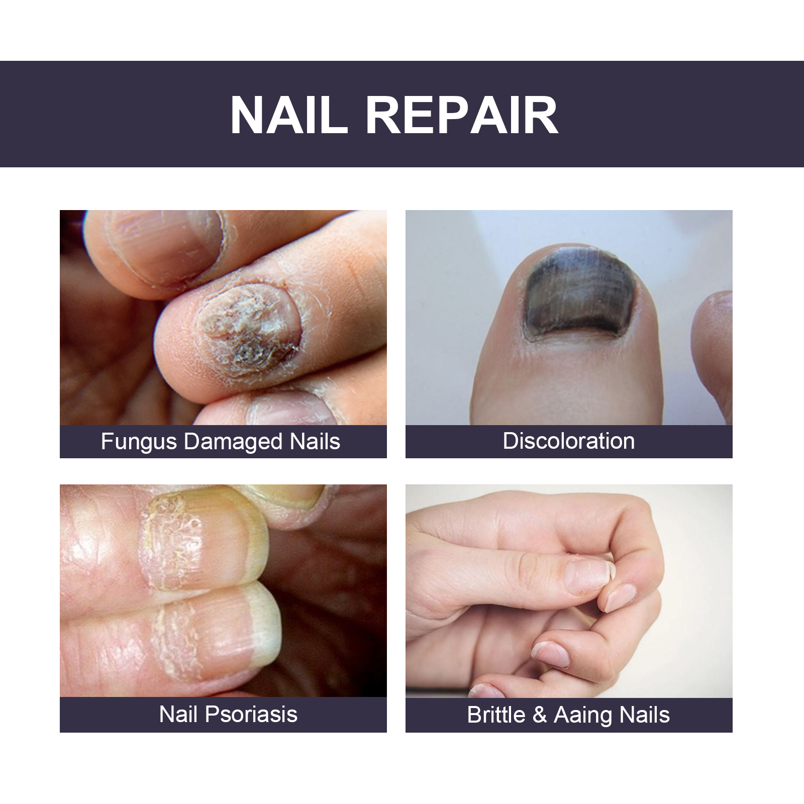 Examples of brittle discolored and uneven nails