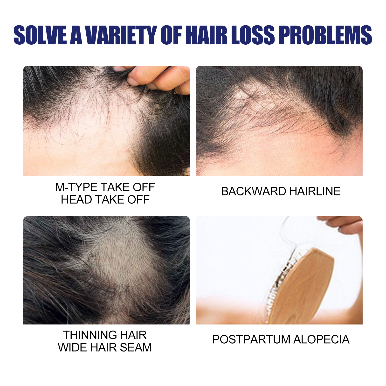 Hair thinning patterns shown around hairline and crown