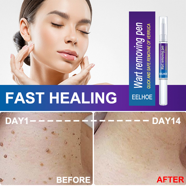 Day 1 to Day 14 advertised wart care comparison graphic
