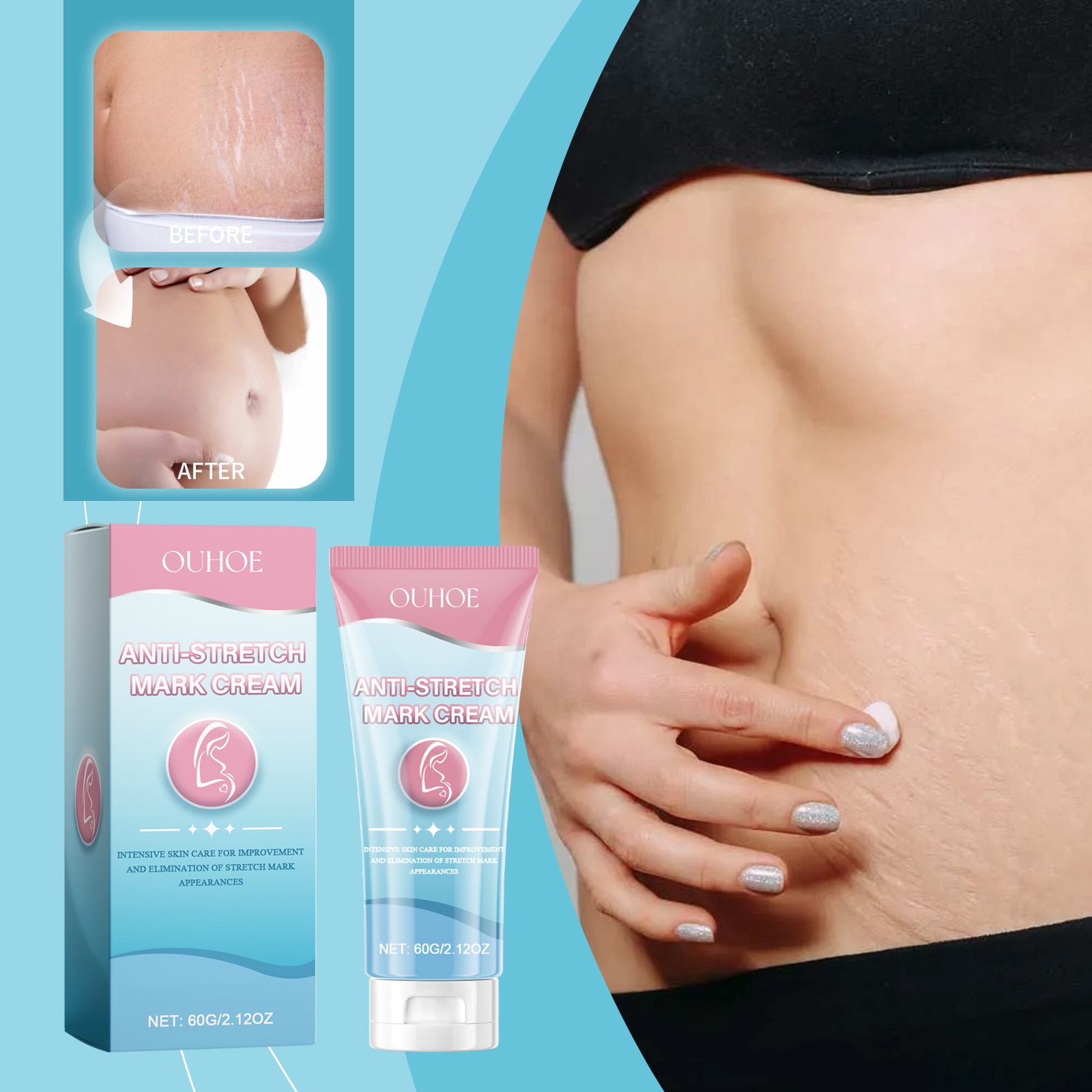 Postpartum abdomen care scene with stretch mark cream