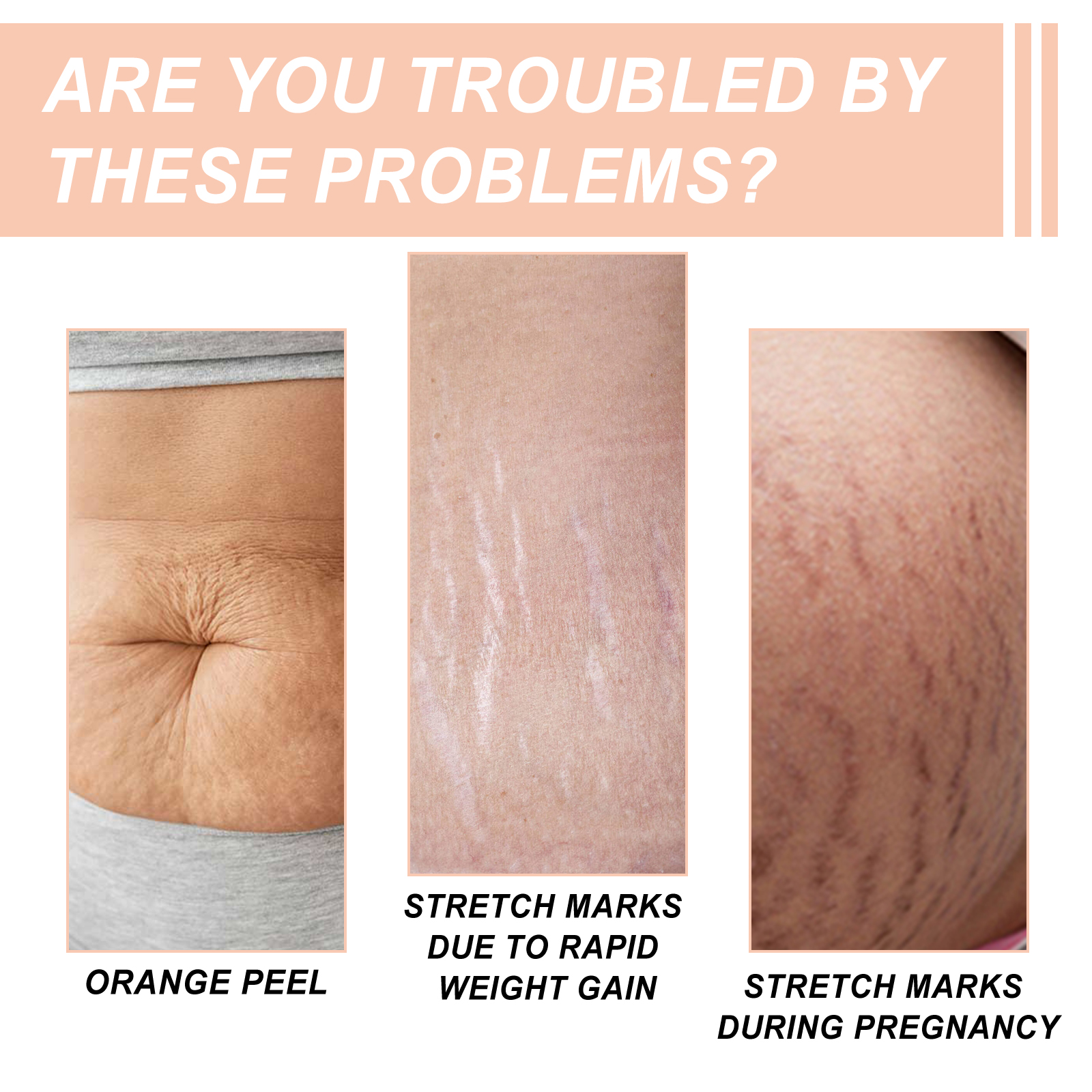 Close-up images of pregnancy and weight-change stretch marks