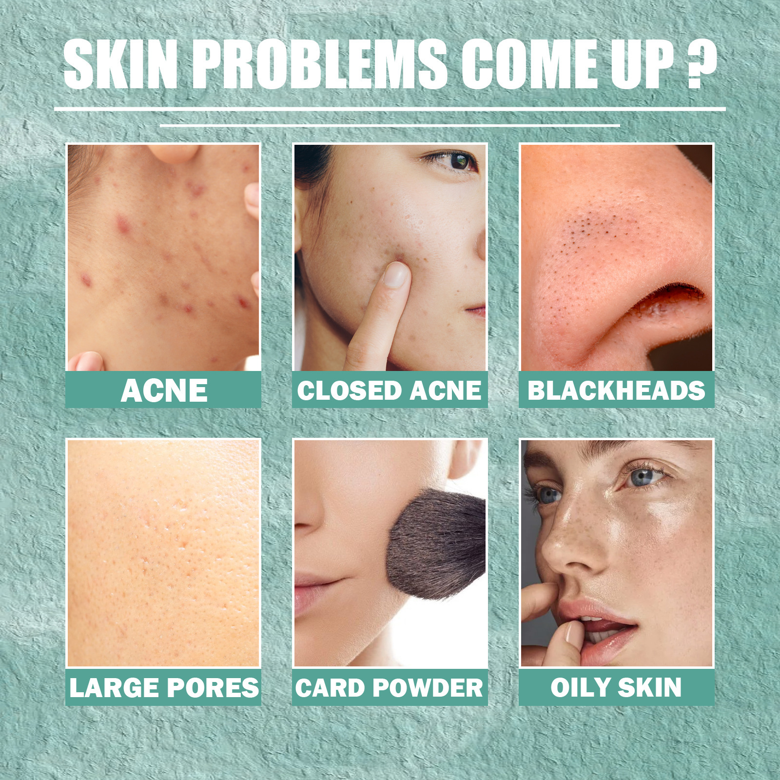 Acne cream claims for blackheads pores and oily skin