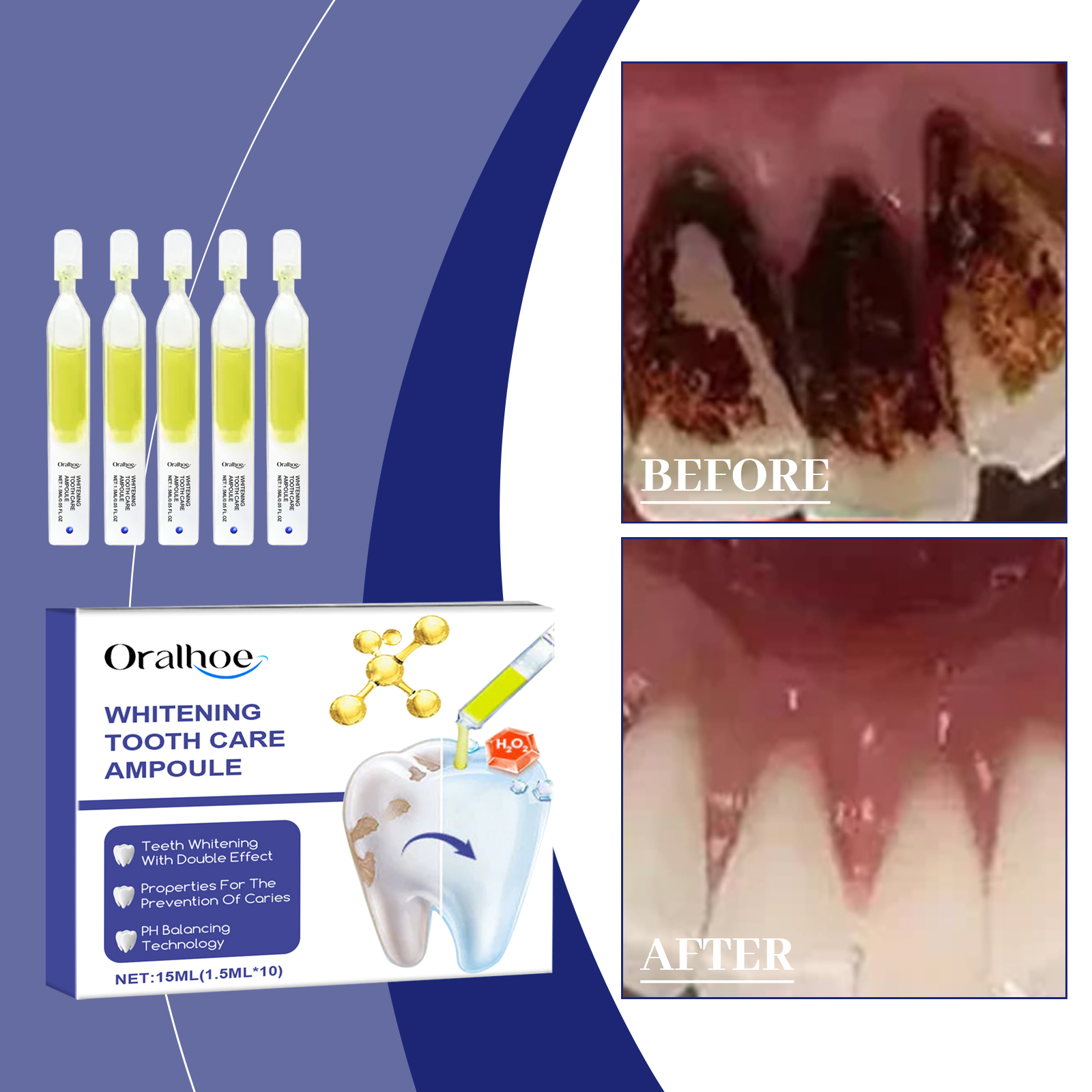Before and after panel showing cleaner-looking tooth appearance